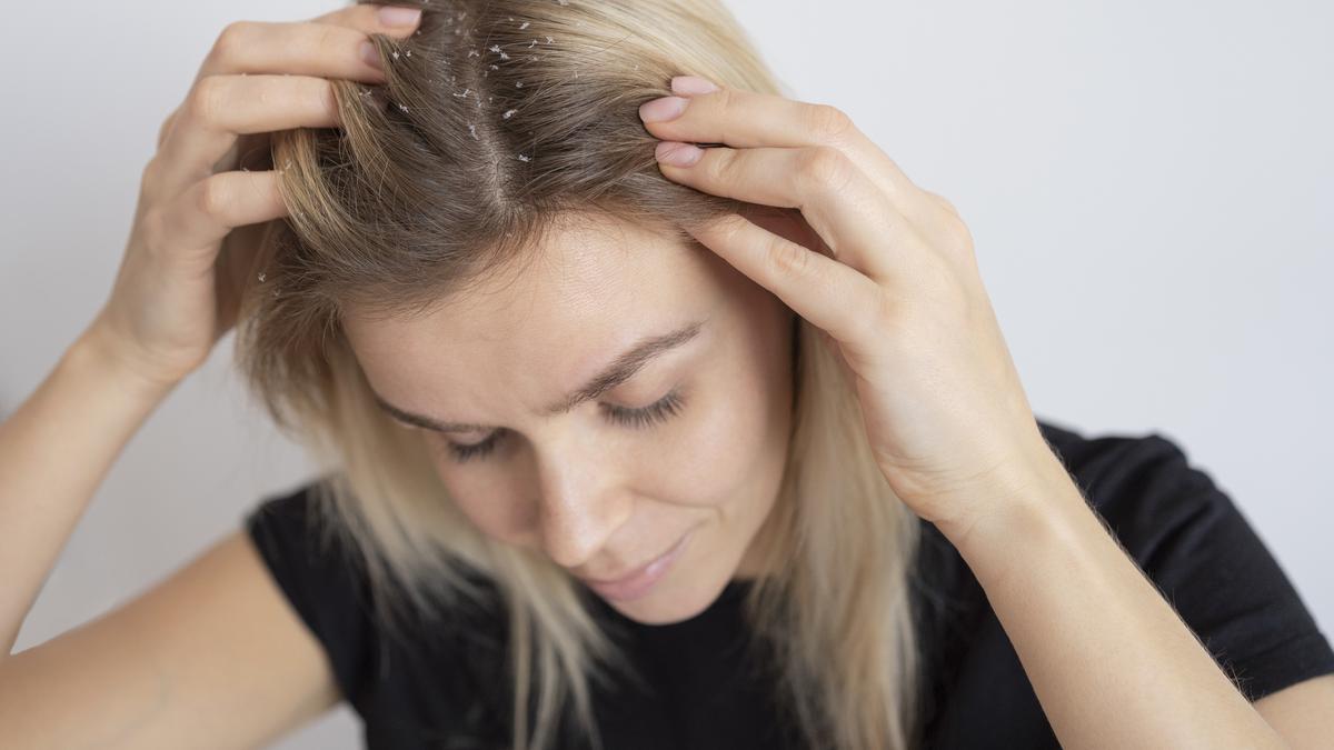 6 Tips Ampuh Merawat Rambut Rontok dan Berketombe, Sudah Pernah Coba?