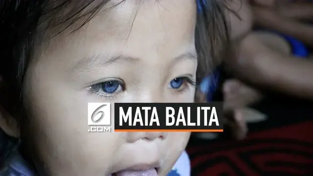 VIDEO: Mata Balita Berubah Warna, Begini Penjelasan Dokter