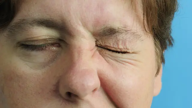 Terlihat Mirip, Bell's Palsy Sering Disangka Stroke