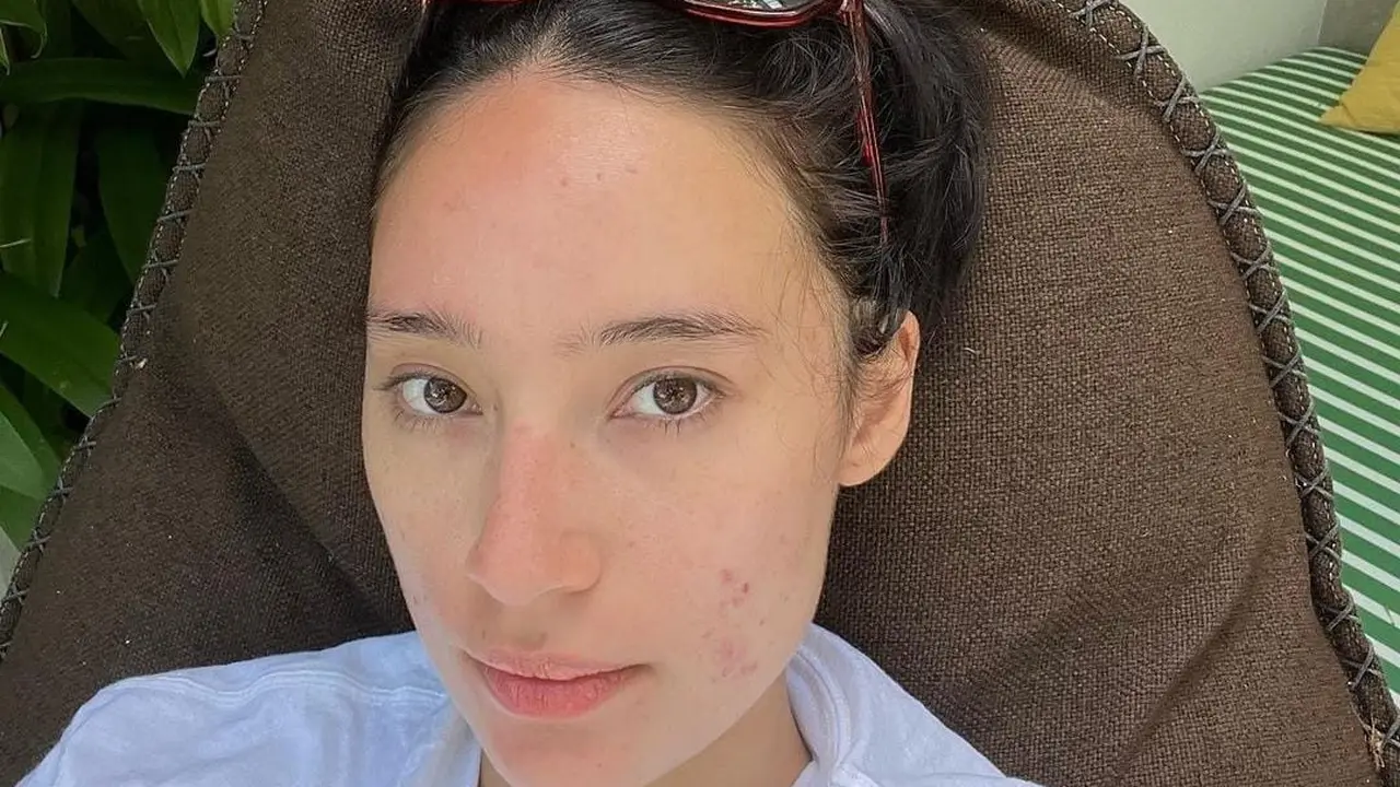 Tatjana Sapira mengunggah foto wajah penuh jerawat