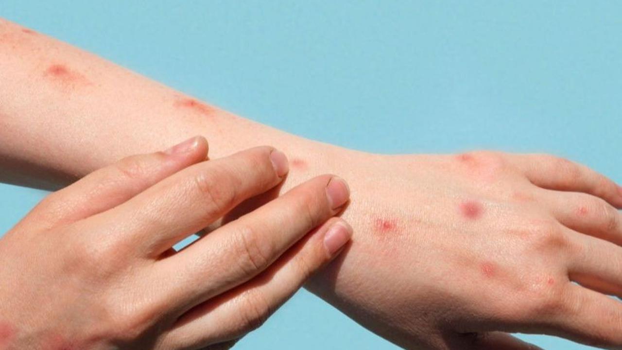 Risiko Komplikasi Herpes Zoster