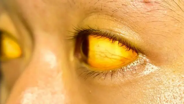 Apakah Penyakit Kuning Berbahaya