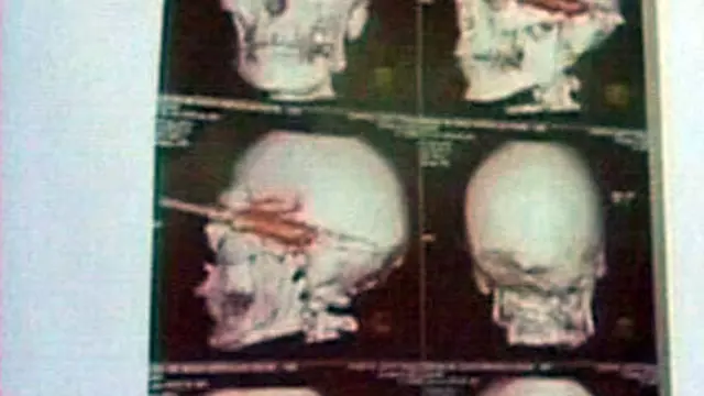 Terkena Tombak di Kepala, Pria Brasil Tetap Hidup