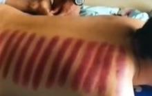 Benarkah Kerokan Bisa Mengeluarkan Angin Berlebih di Dalam Tubuh?