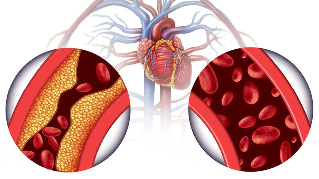 Langkah Mudah yang Bisa Dilakukan Setelah Konsumsi Makanan Tinggi Kolesterol