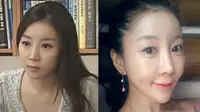 Presenter Wanita `Rombak Wajah` Agar Dagu Berbentuk Hati