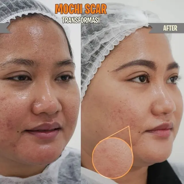 Tren Mochi Scar by Dermapro Jadi Solusi Menghaluskan dan Meregenerasi Kulit