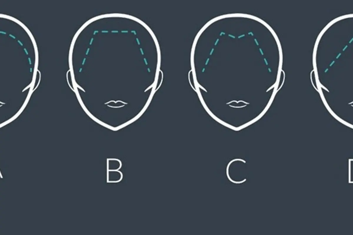 [Bintang] Garis Batas Rambut Kamu Bentuknya Kayak Gimana? Yuk, Ketahui Artinya!