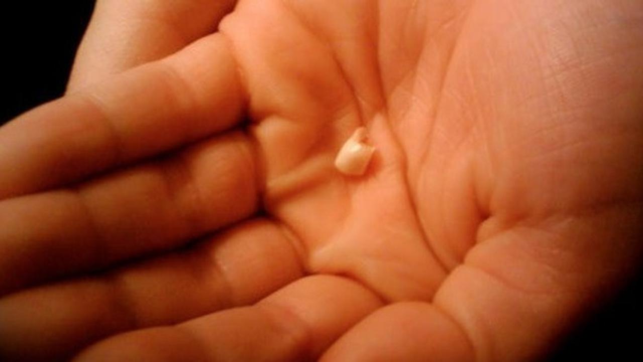 ilustrasi gigi copot