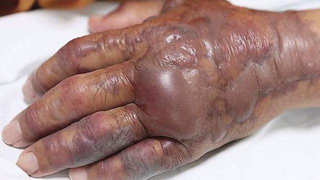 Lengan Pria Ini Diamputasi Usai Makan Sushi