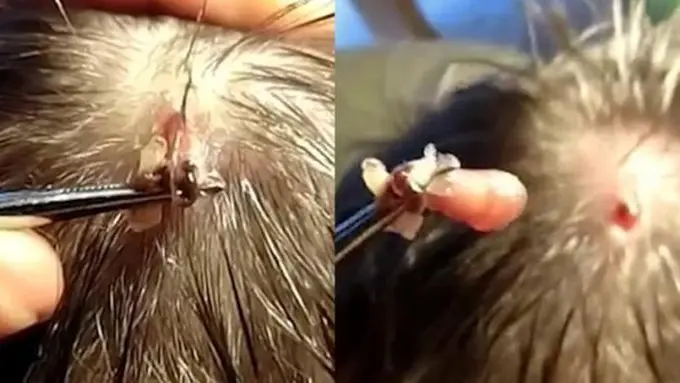 Ngeri! Seekor Belatung 'Ngekos' di Kepala Pria Ini! 