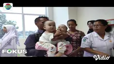 Bayi kembar siam dempet di Tapanuli Utara, Sumatra Utara, jalani operasi pemisahan tubuh di RSUP Haji Adam Malik, Medan.