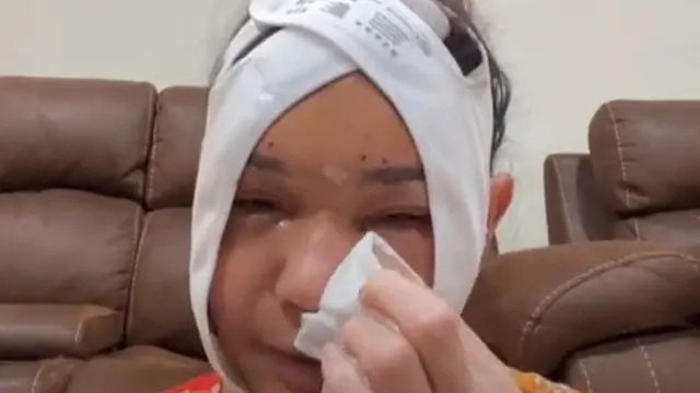 Wajah Bunda Corla Usai Oplas
