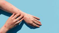 Tips Menjaga Kesehatan Kulit Bila Terserang Monkeypox/copyright shutterstock/Marina Demidiuk