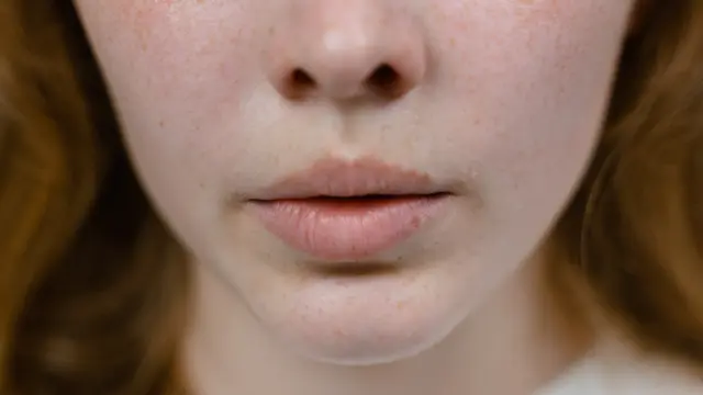 Ilustrasi Melasma