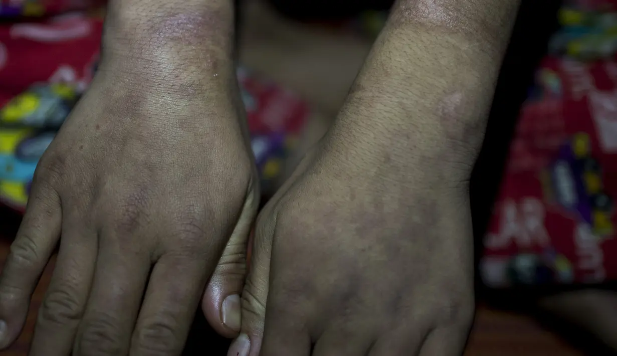 Gadis berusia 14 tahun, Khin Khin Tun memperlihatkan bekas luka di tangannya di Mawlamyine (13/2). Khin Khin Tun menerima 30.000 kyat, atau sekitar Rp 300 ribu per bulan. (AFP PHOTO/YE AUNG THU)