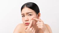 9 Cara Cepat Mengempiskan Jerawat dengan Aman, Kembalikan Kepercayaan Diri