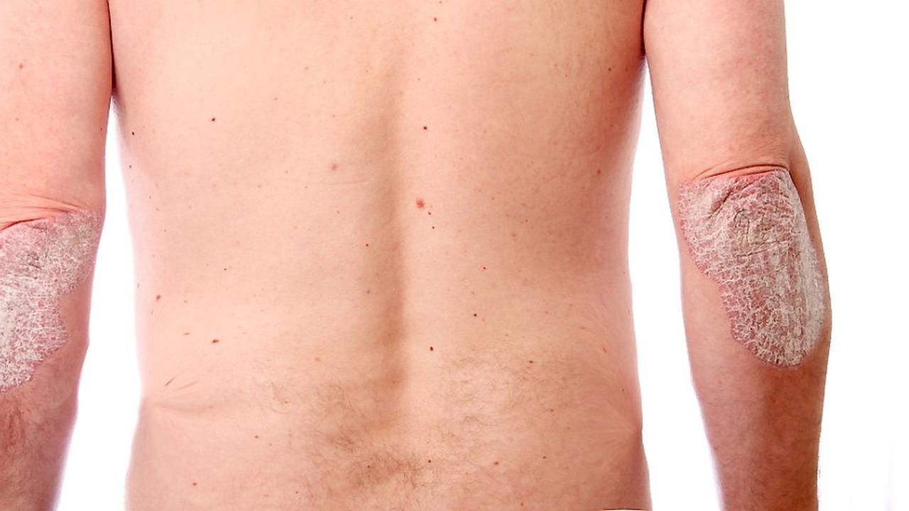 Apa Sih Psoriasis Itu?