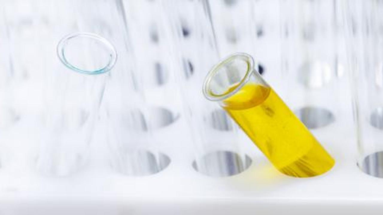 5 Hal yang bisa diungkap lewat urine