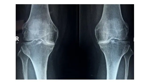 Kenali Lebih Dini Osteoporosis dan Osteoarthritis