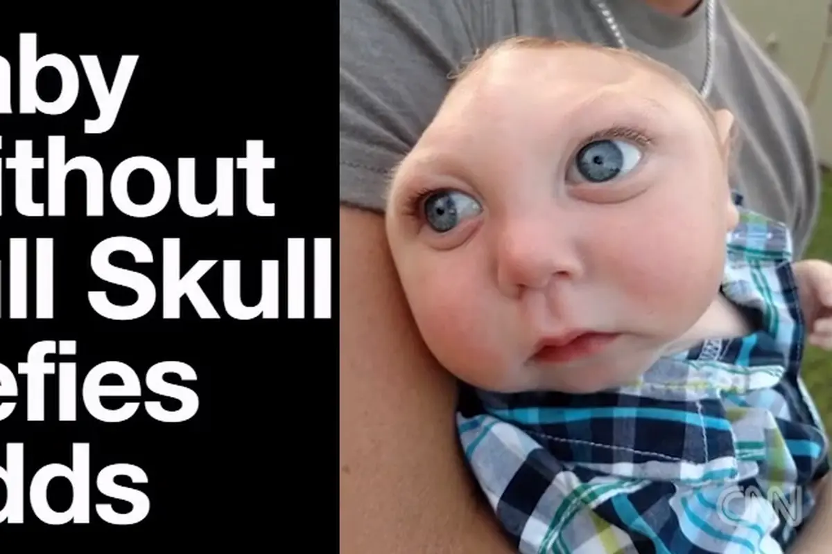 Bayi Ini Terlahir dengan Tempurung Kepala yang Tidak Sempurna