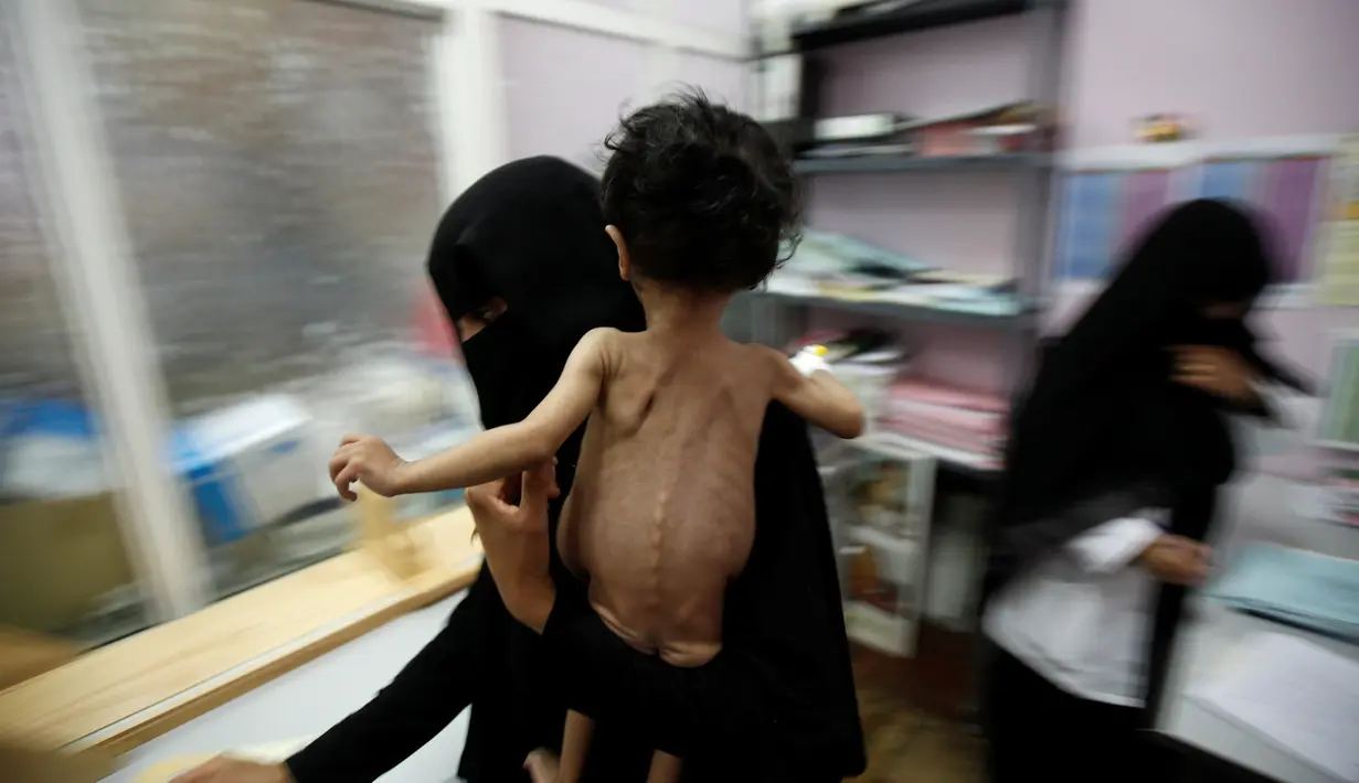 Seorang wanita menggendong anaknya saat berada di rumah sakit di Sanaa, Yaman pada 27 September 2016. Bangsal perawatan intensif di rumah sakit Yaman dipenuhi dengan anak-anak malnutrisi. (REUTERS/Khaled Abdullah)
