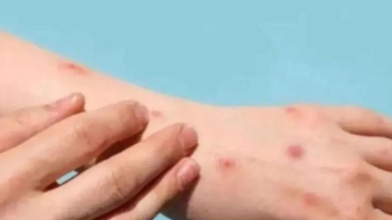 Kenali Gejala dan Cara Mengatasi Cacar Monyet Usai Santri di Meranti Meninggal Diduga Terinfeksi