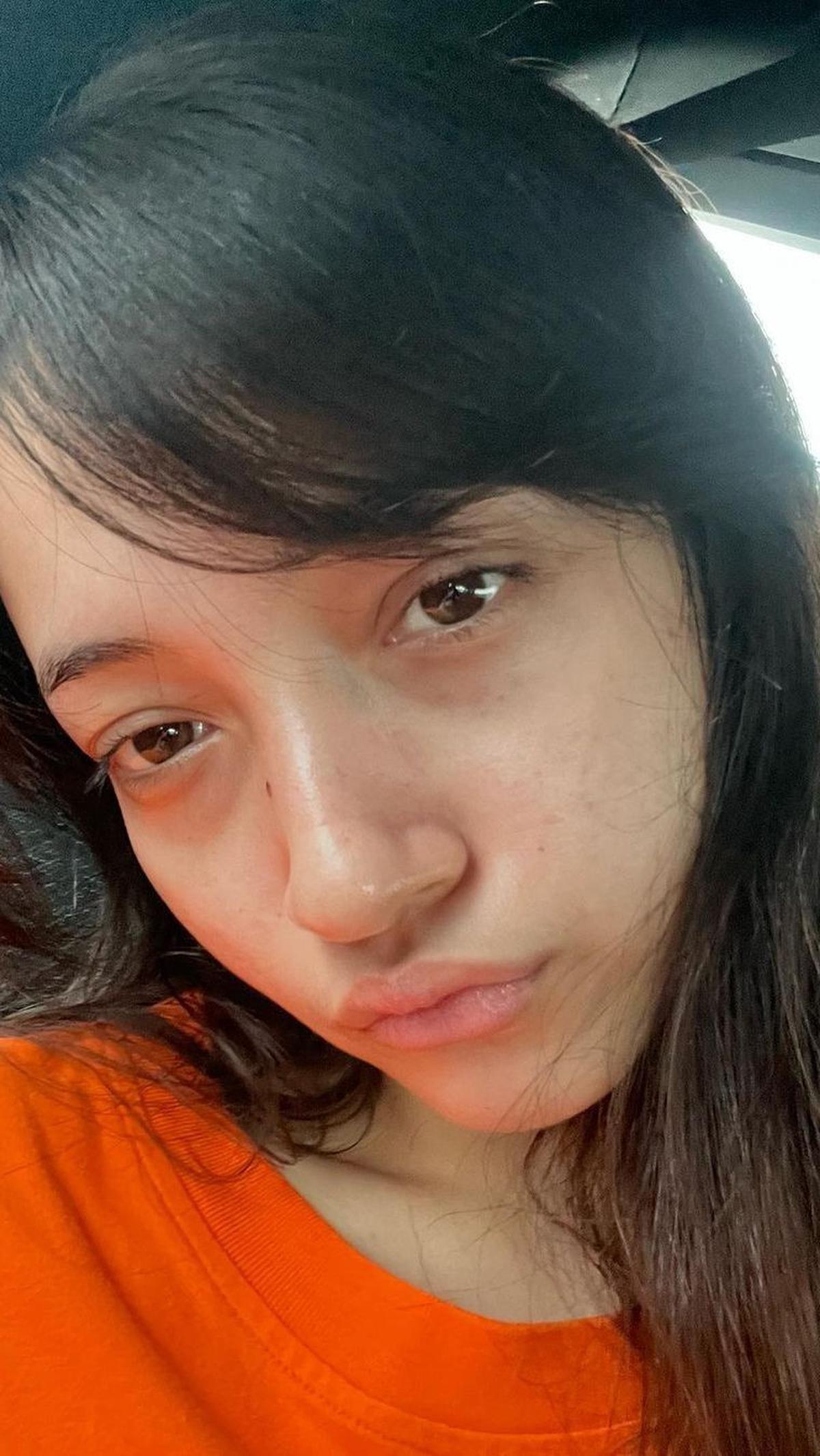 Megan Domani juga menyebut dirinya sebagai acne fighter. Acne Fighter merupakan sebutan untuk orang yang mengalami masalah kulit berjerawat yang cukup serius, hingga bisa berdampak buruk terhadap mental seseorang.