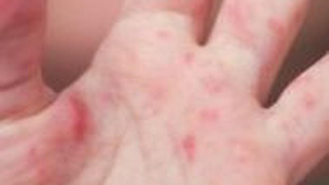Rubella biasanya sembuh sendiri, tetapi gejala seperti demam dan sakit dapat diatasi dengan obat penghilang rasa sakit. Penting untuk hindari memberikan aspirin pada anak-anak atau remaja karena berisiko sindrom Reye.