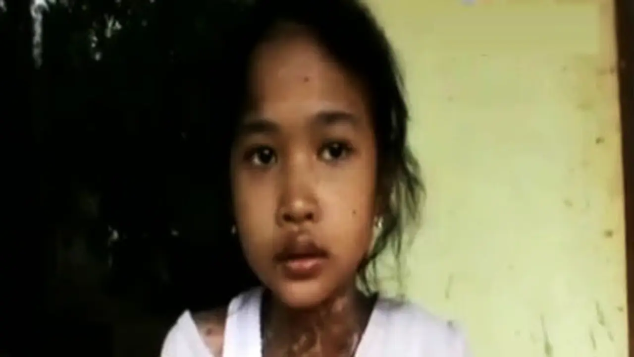 Bocah-Penderita-Penyakit-Kulit