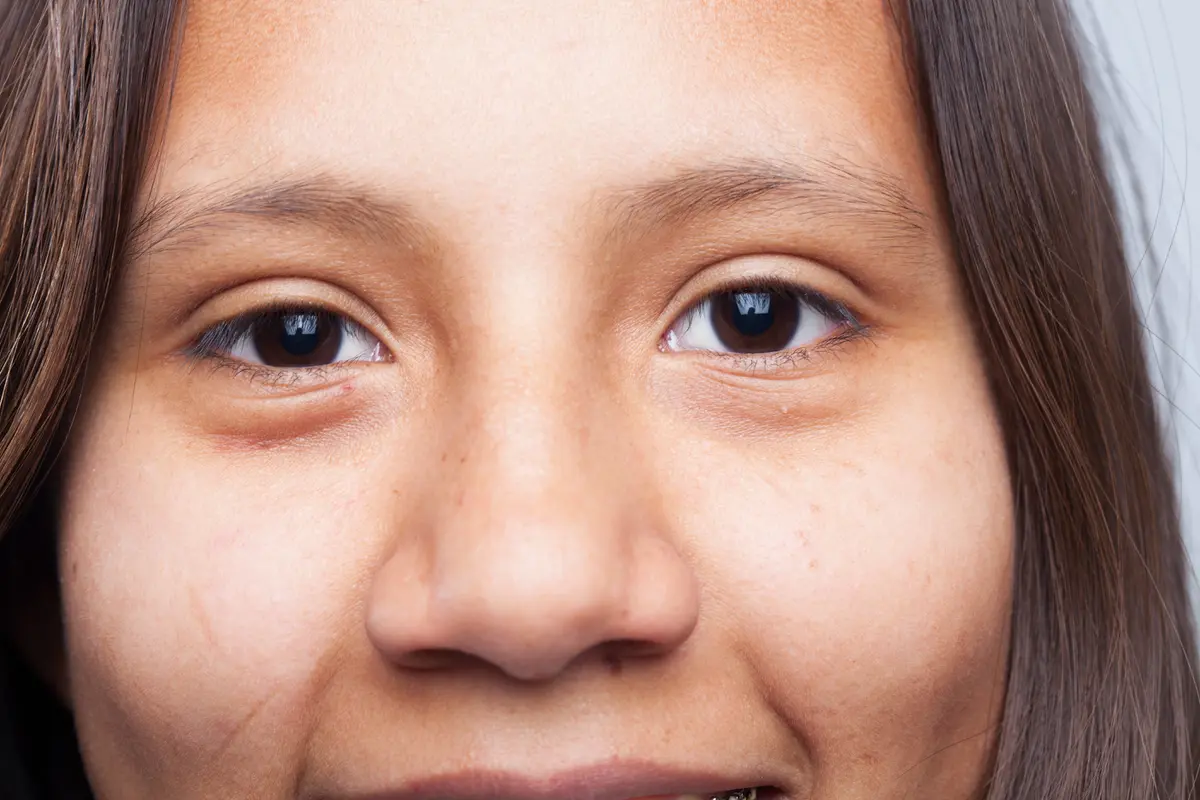 Ptosis