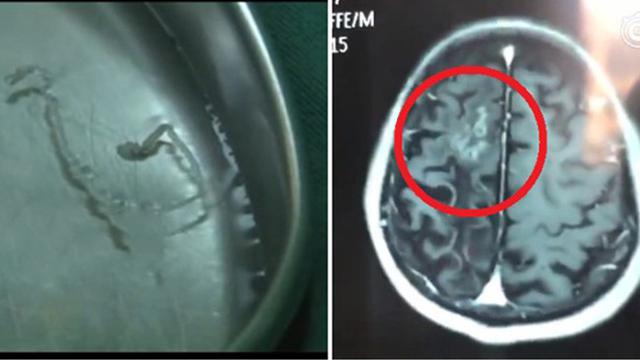 Sakit Kepala Selama 30 Tahun, Ternyata Cacing Bersarang di Otak Pria Ini