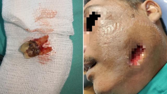 Pakai Minyak Rem Obati Gigi yang Sakit, Ini yang Terjadi