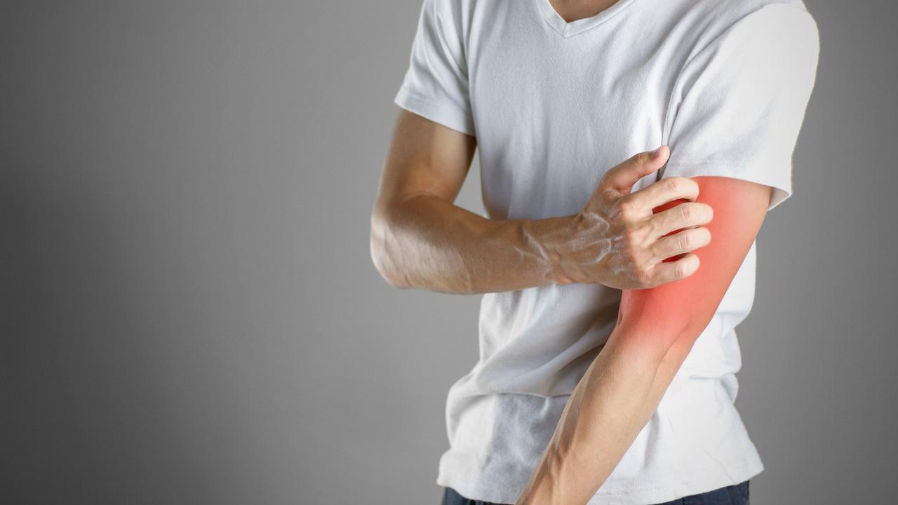 Scabies Adalah Infeksi Kulit, Kenali Tanda-Tanda dan Penyebabnya