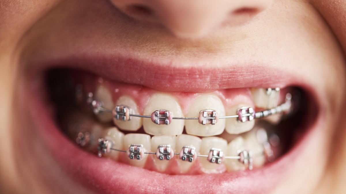 Gigi Tidak Rapi Ternyata Bisa Picu Masalah Mulut, Dokter Sarankan Perawatan Ini