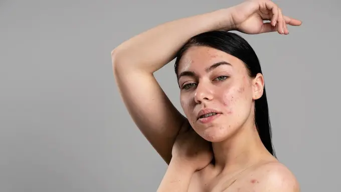 ilustrasi jerawat conglobata. Sumber: freepik