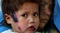 ISIS Sebabkan 500 Penduduk Suriah Derita Leishmaniasis