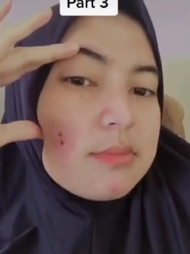 jerawat