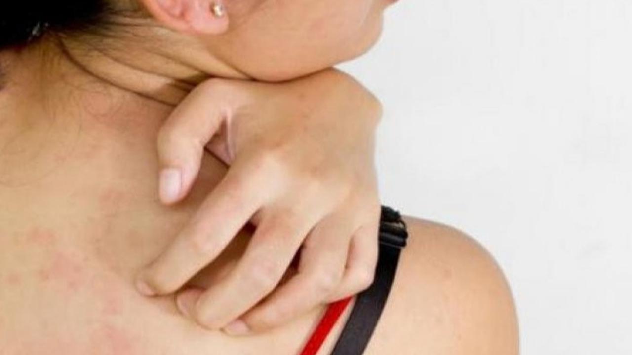 Tanda-tanda Diabetes yang Bisa Dilihat dari Kondisi Kulit, Tidak Boleh Diabaikan