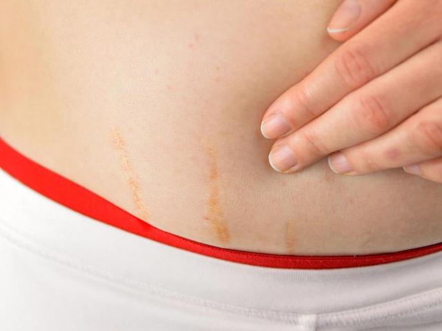 Gerakan Mencintai Stretch Mark Bagi Para Wanita Mendunia Lifestyle Liputan6 Com
