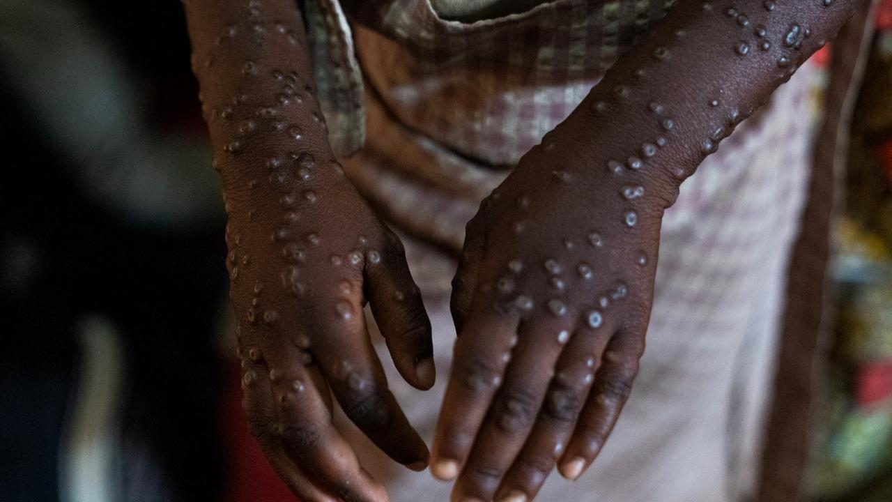 Menkes Temukan 88 Kasus Mpox di Indonesia, Semua Pasien Sudah Sembuh