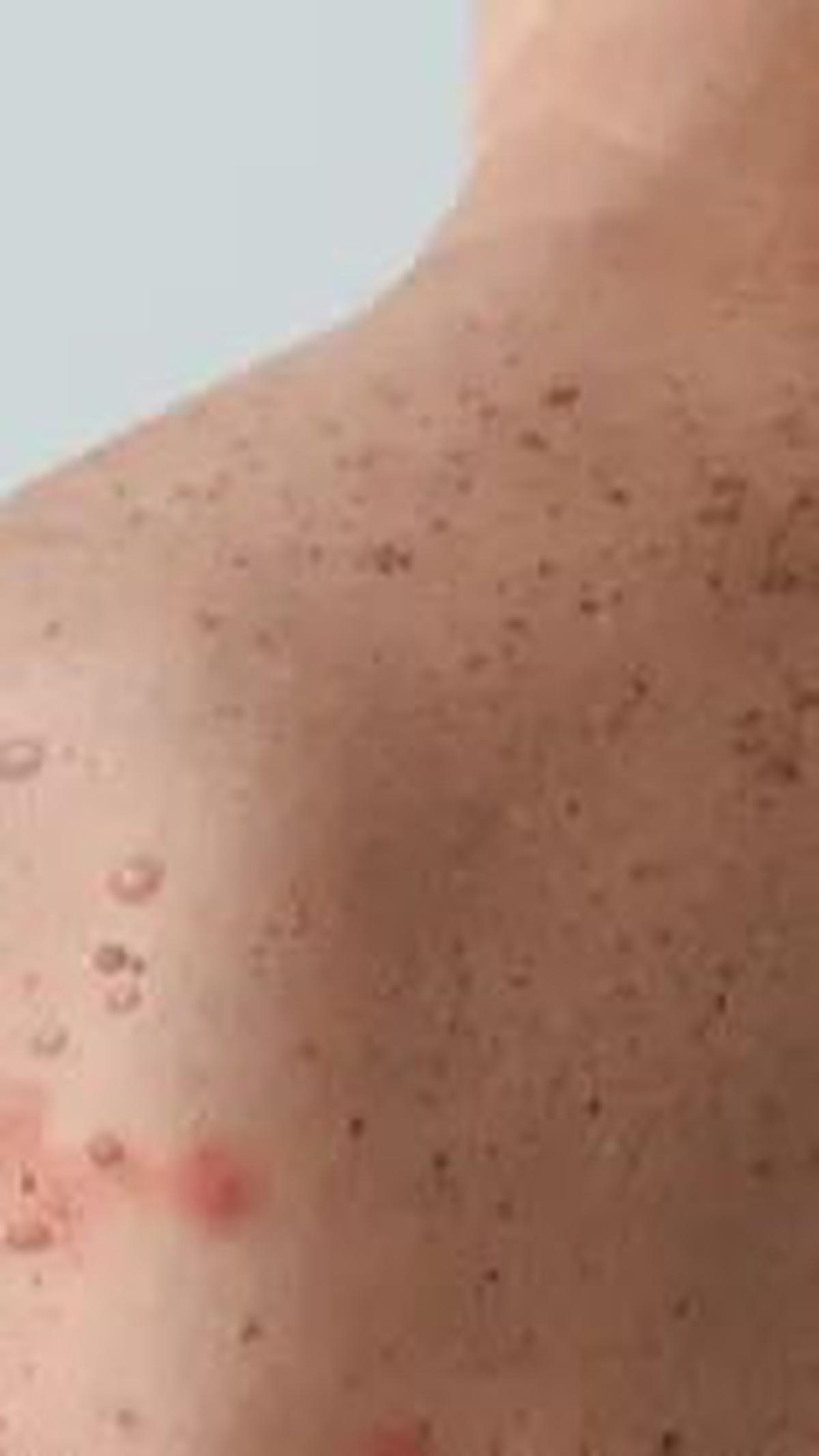 Cacar air, pada sisi lain, disebabkan oleh virus varicella-zoster (VZV) dan menyebar melalui kontak dengan lepuh kulit yang terinfeksi atau percikan air liur saat batuk atau bersin. Penderita cacar air rentan terinfeksi jika belum pernah menderita atau di