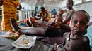 Seorang anak tampak kurus akibat gizi buruk yang ia alami di sebuah klinik di Lankien, Sudan Selatan, (8/4).Tingkat kelaparan di Sudan selatan memang sangat mengkhawatirkan. (Albert Gonzalez Farran / cds / AFP)