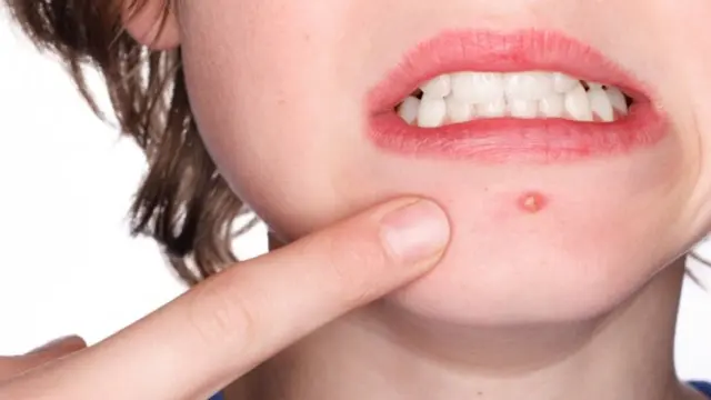 Ini Dia yang Menyebabkan Jerawat pada Orang Dewasa