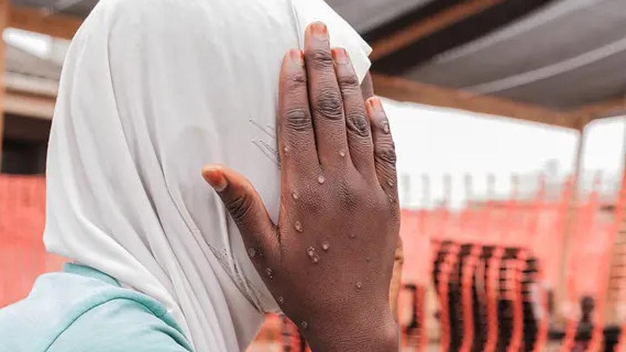Bisa Menular Melalui 4 Cara, Mpox Juga Bisa Ditularkan dari Ibu ke Janin