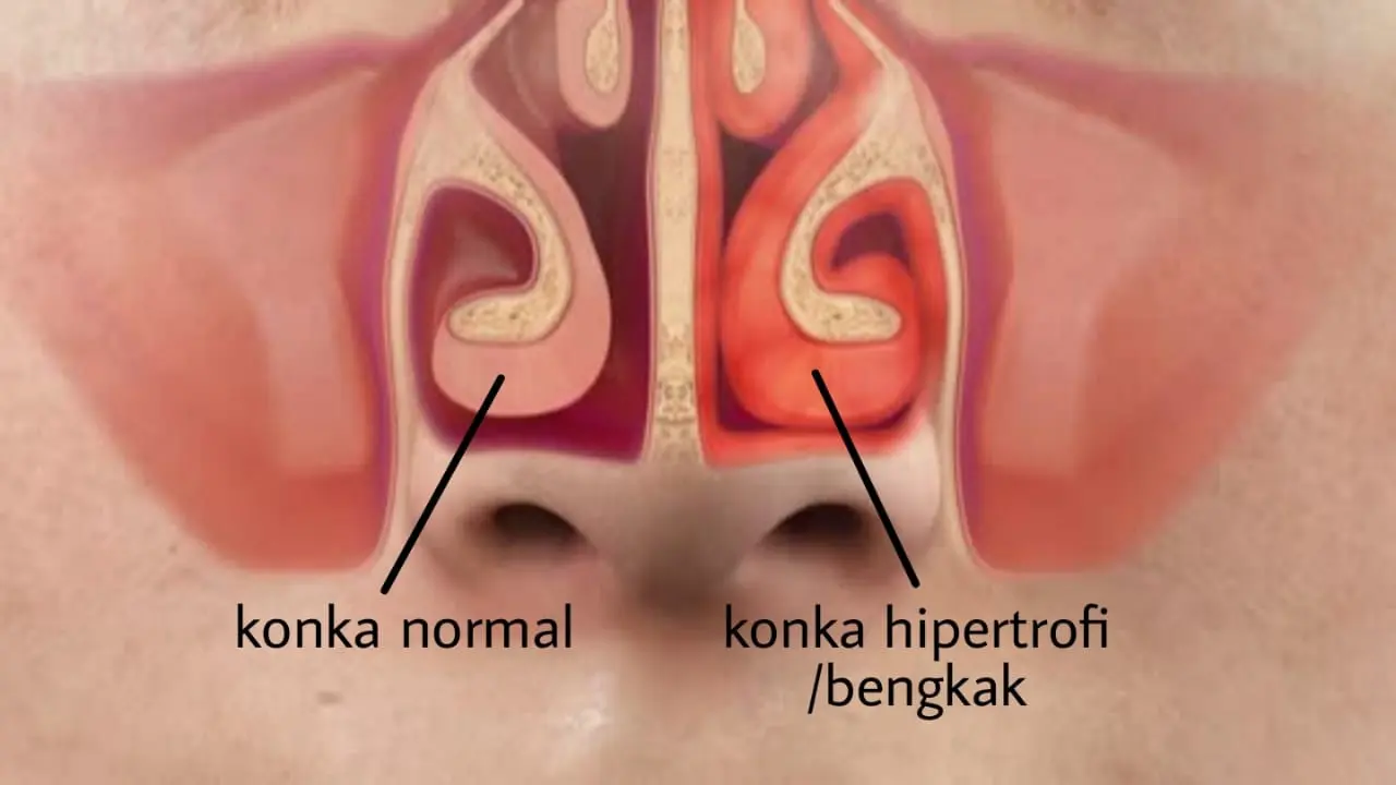 Jangan Sepelekan Bahaya Konka Hidung Membengkak