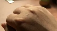 6 Cara Mengatasi Keloid yang Tidak Bisa Hilang Bertahun-Tahun, Dijamin Bikin Lebih Percaya Diri!