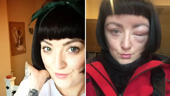 Alergi Cat Rambut, Wajah Perempuan Cantik Ini Bengkak-bengkak