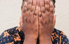 8 Senjata Rahasia yang Bisa Dilakukan untuk Menghentikan Penyebaran Mpox