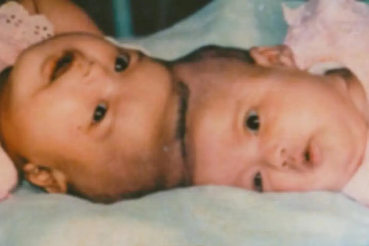 Masih Ingat Bayi Kembar Siam Ini? Sekarang Mereka Menjadi...